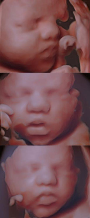 Silhouette Imaging ultrasound
