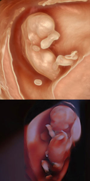 Silhouette Imaging ultrasound