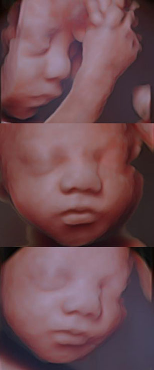 Silhouette Imaging ultrasound