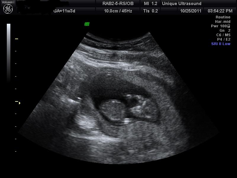 gender check ultrasound