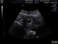 1st Trimester Scan at 5 Weeks 2 days - from Unique Ultrasound