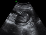 gender check ultrasound